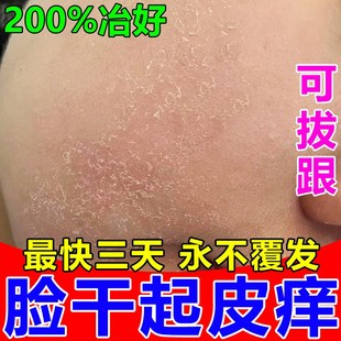 脸起皮干燥有碎屑修复霜滋润皮肤下巴过敏红痒脱皮起癣男女士药膏