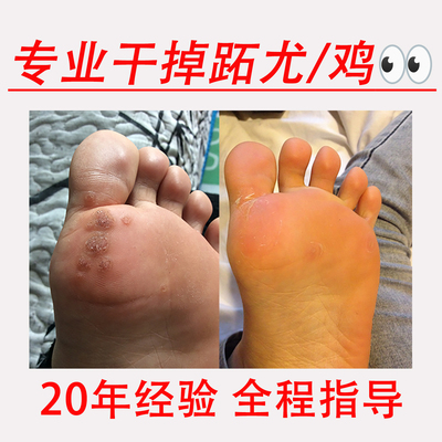 尚发研跖疣专用膏去除祛寻常疣病毒疣瘊净鸡眼膏足部脚趾跖疣神器