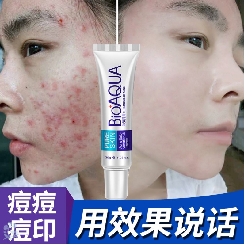 祛痘膏青春痘粉刺修护脸上治痘印产品逗去痘痘修覆痘疤消男女除豆