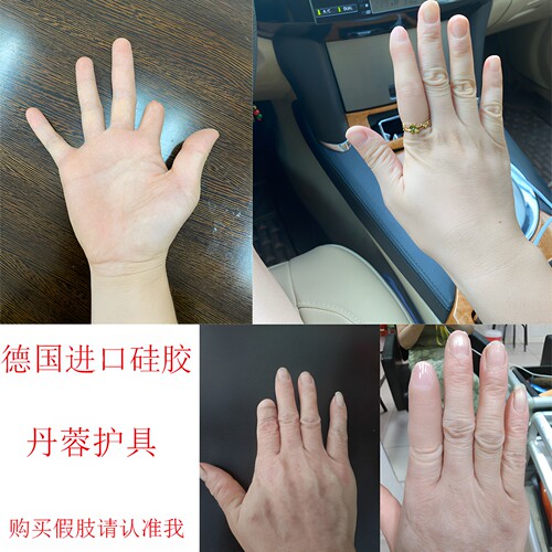 丹蓉通用上海手指假肢硅胶义肢