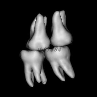 mimics下颌骨 颞下颌关节 提取 分离 口腔三维重建