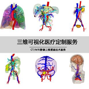 心胸外科三维可视化 CT数据三维重建 3D医学模型 dicom MRI 转STL