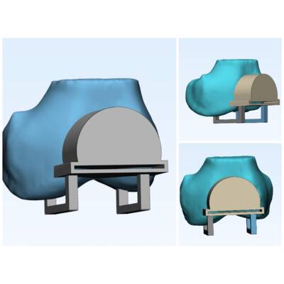 CT/MRI，DICOM薄层数据，mimics三维重建，膝关节3D导板设计