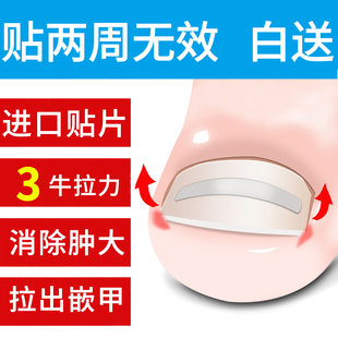 欧美嵌甲技术甲沟发炎正甲贴嵌甲矫正贴矫正器拉拉贴修脚专用刀