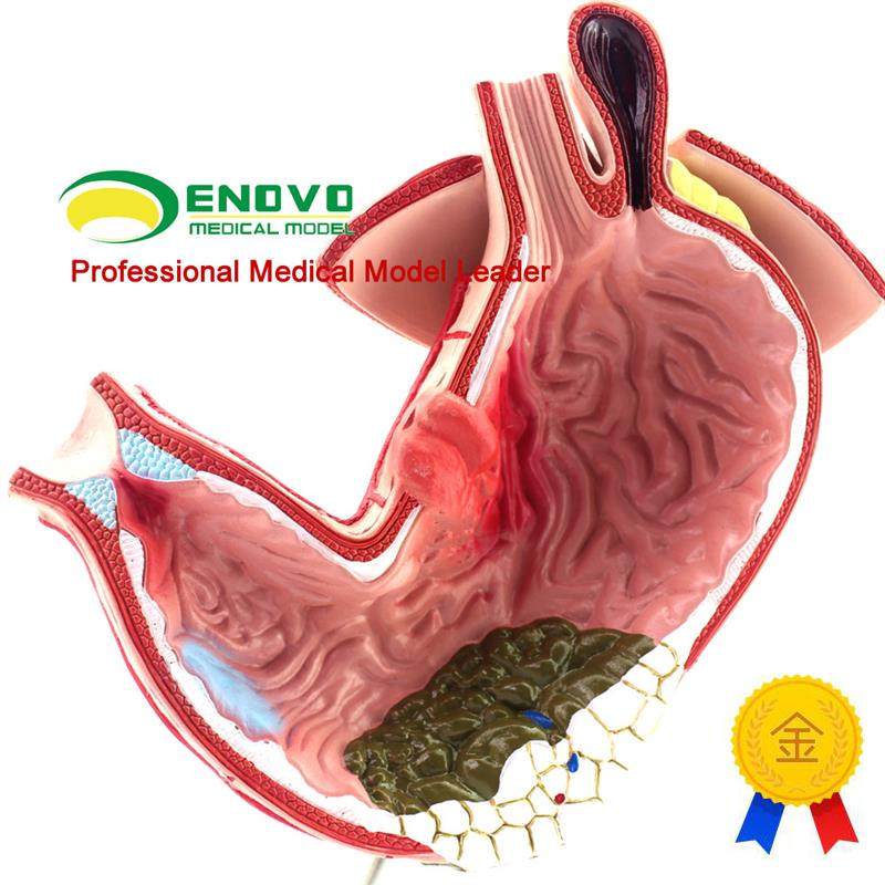 颐诺正品医用胃部疾病q演示模型人体胃解剖消化系统模型消化科