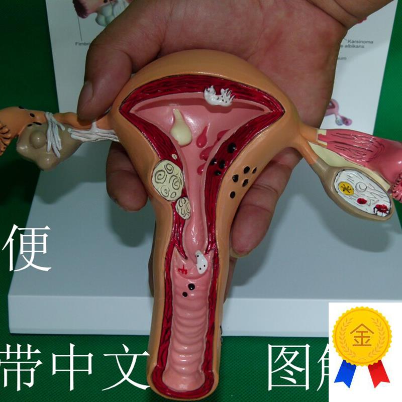 子宫卵巢病理病变模型生殖科医药G礼品模型女性子宫阴道模型