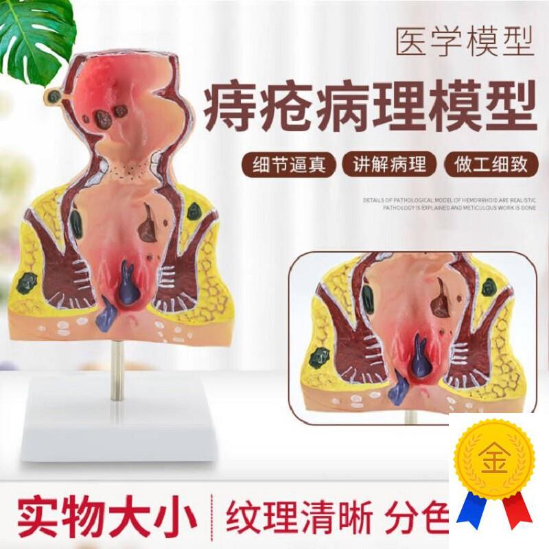 大号人体直肠模型结肠病理直肠痔疮直肠常见病模型直肠Z和肛管模