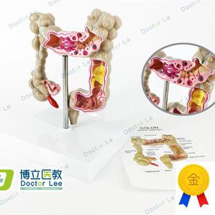 正品人体结肠病变模型肛肠科消化科大肠J模型医用人体解剖肠道模