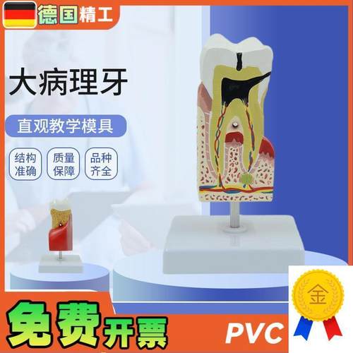 德国】人体大f病理牙齿模型蛀牙模型蛀牙放大牙齿解剖病理牙病