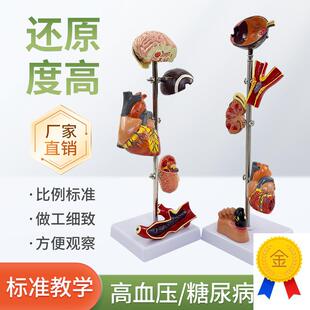 高/血压模型糖尿/病变内u脏模型病态血压病理脑眼心脏肾脏血管