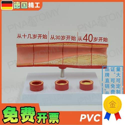 德国】人体动脉h血管堵塞模型心脑血管血栓/硬化模型教学心脑血管
