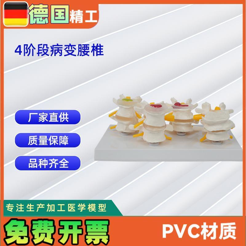 德国】人体4阶i段病态腰椎比较模型人体骨骼模型医学教学教具