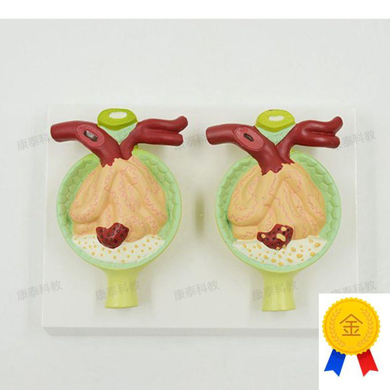 蛋白尿模型病理肾脏n肾小球临床医药促销医患示教泌尿系统器官肾