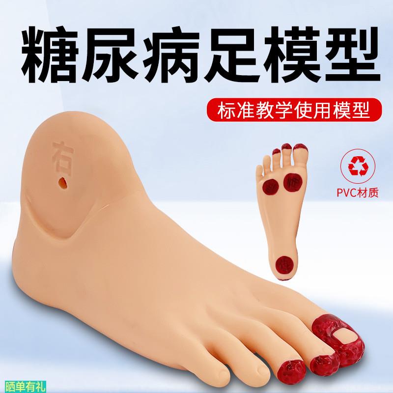高级糖尿病足护理模型 足部病理变化模型 脚趾感染示教教具