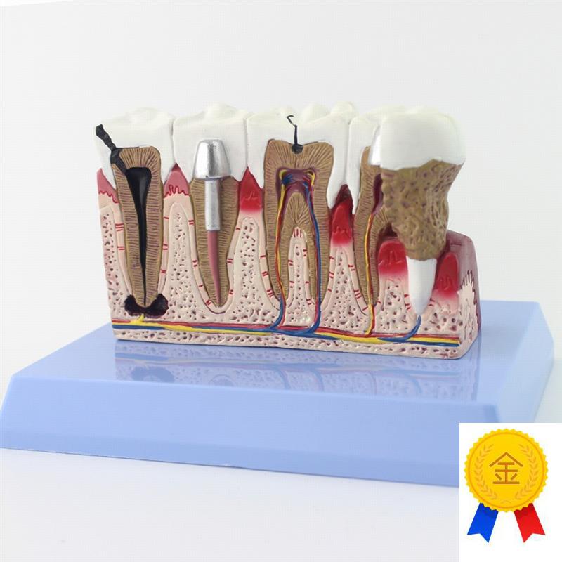 ENOVO颐诺h牙齿模型口腔牙齿科种植模型口腔病理模型口腔医院医患