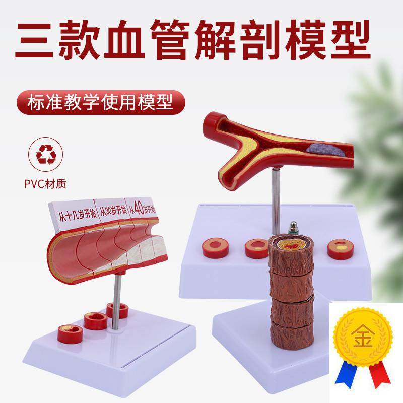 4阶段硬化动g脉病理血管模型病冠心人体病态血管血管解剖模型