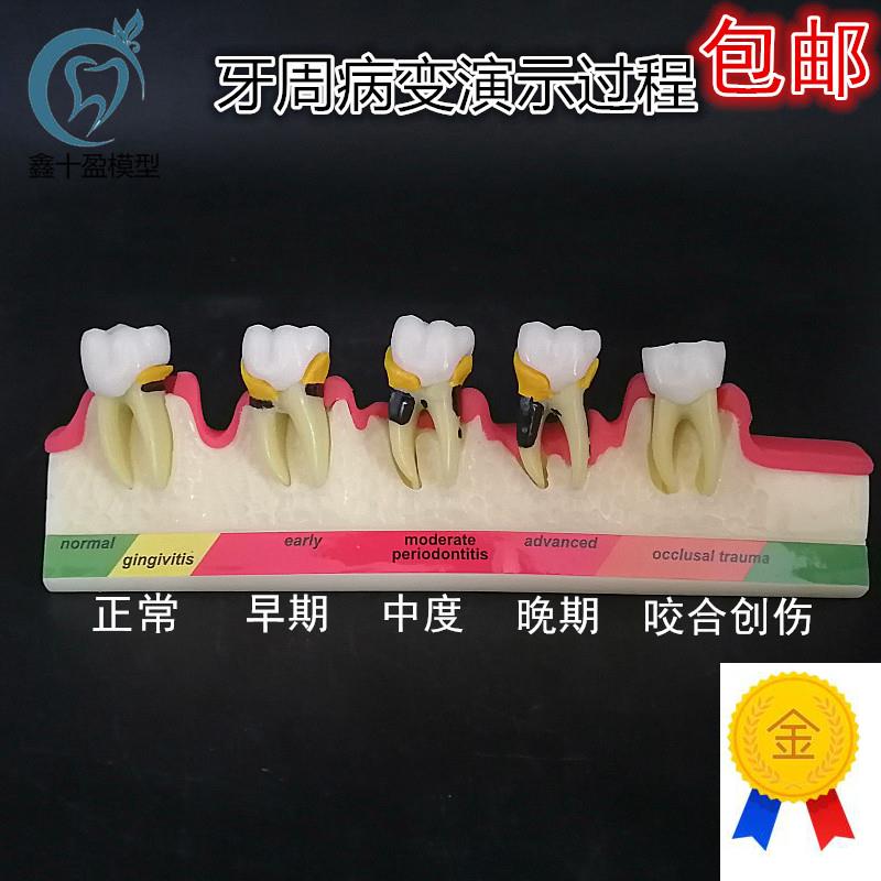 牙齿牙科牙模牙周分类模型牙周并变重的过程牙科T医患沟通展示模
