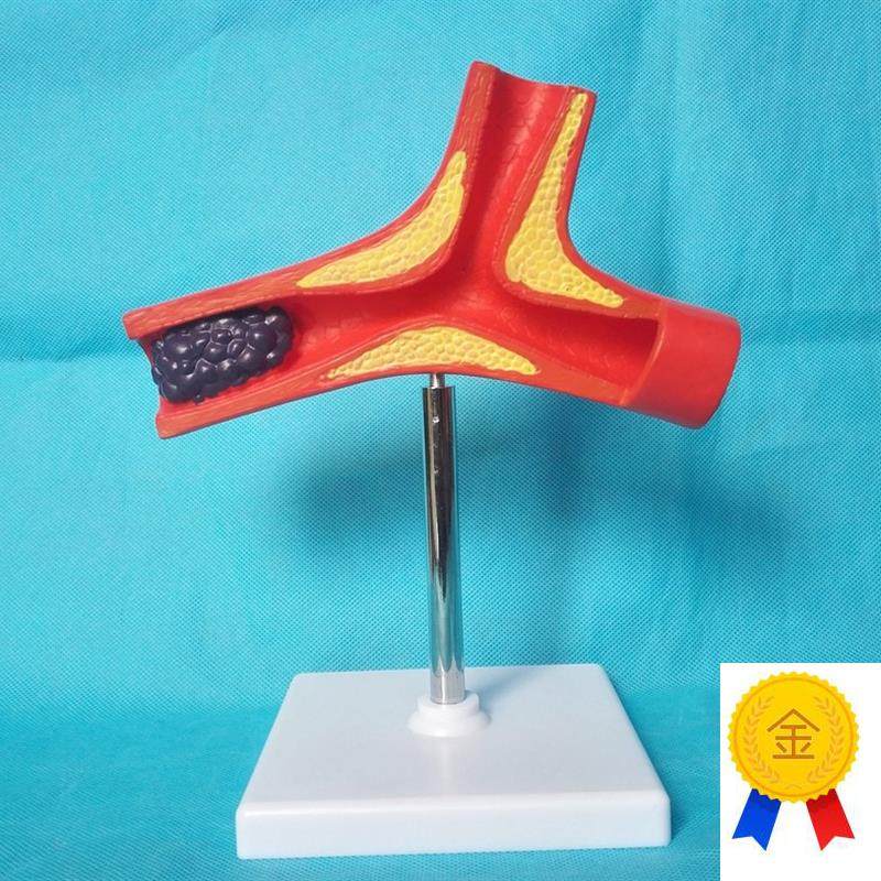人体血管解剖模型病变血管模型W医用教学模型