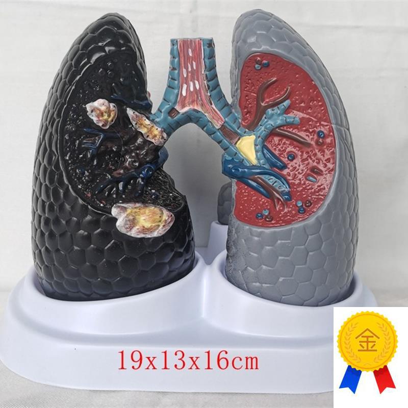 人体吸烟癌变肺模型健康肺模型人类内脏吸烟肺与Z健康肺模型