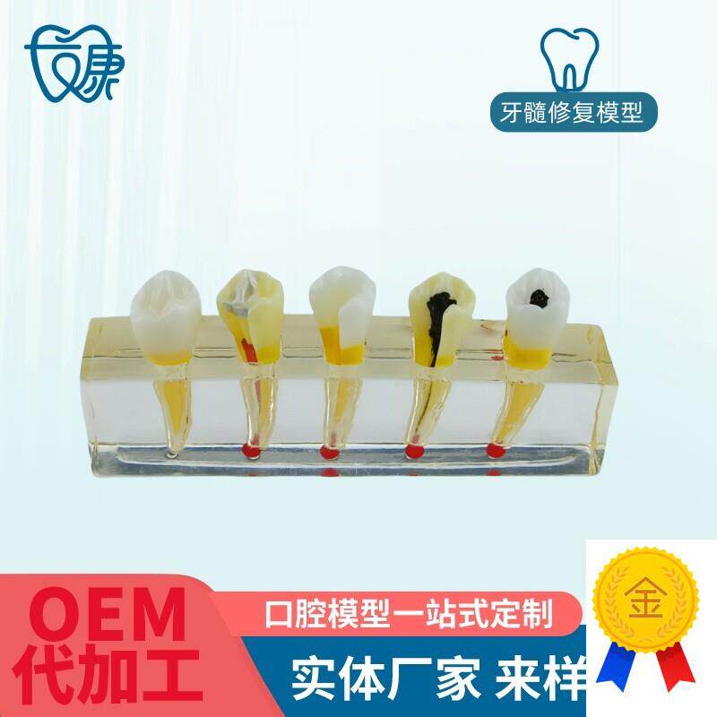 牙科医患沟通病理模型牙髓病修复模型展示S牙髓牙髓治疗模型