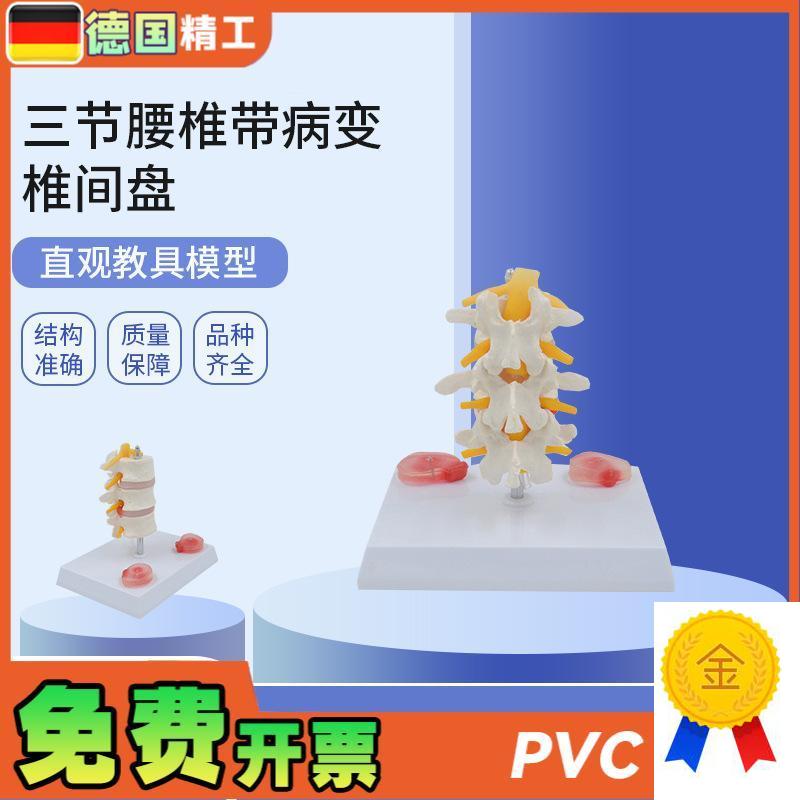 德国】PbNT0131三节腰椎带病变椎间盘病变椎间盘骨骼模型骨科疼痛