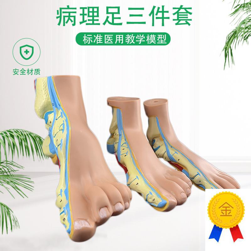 正常足弓形足高弓足模型脚关节C模型爪形足脚部模型解剖医院
