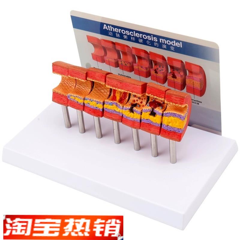 心脑血管堵塞动支脉粥样硬化血栓血液浓度脂肪病理教学用模型道具