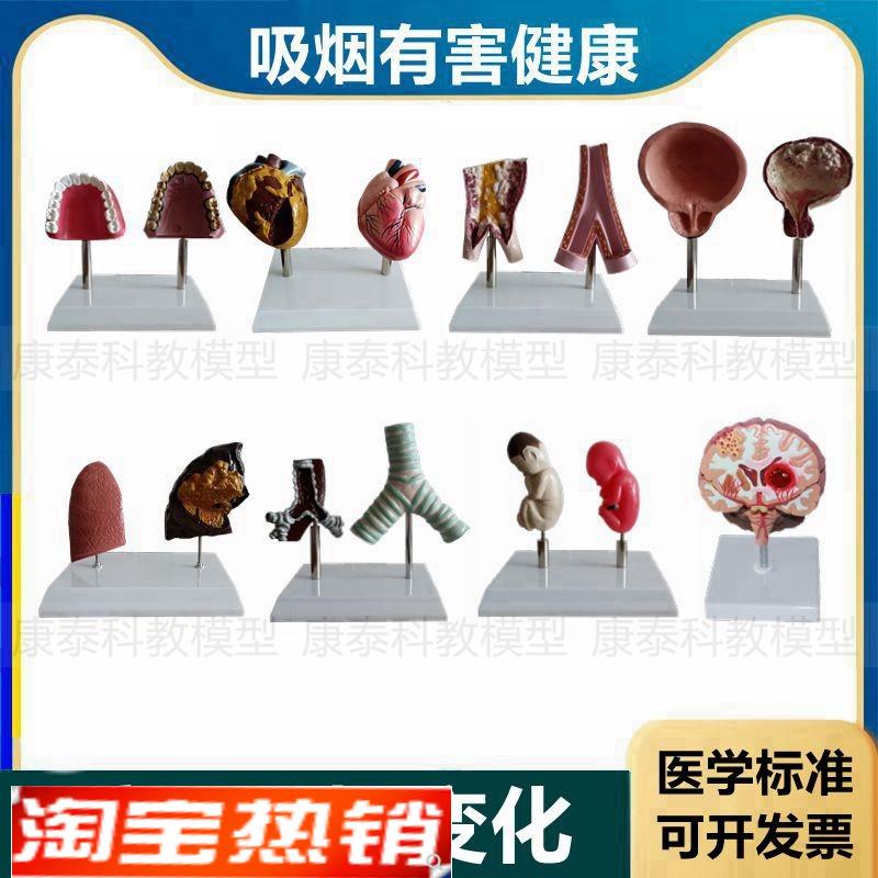 心脏模型病理正常对比吸烟有害心血管肺气管口腔牙齿戒烟警示教具