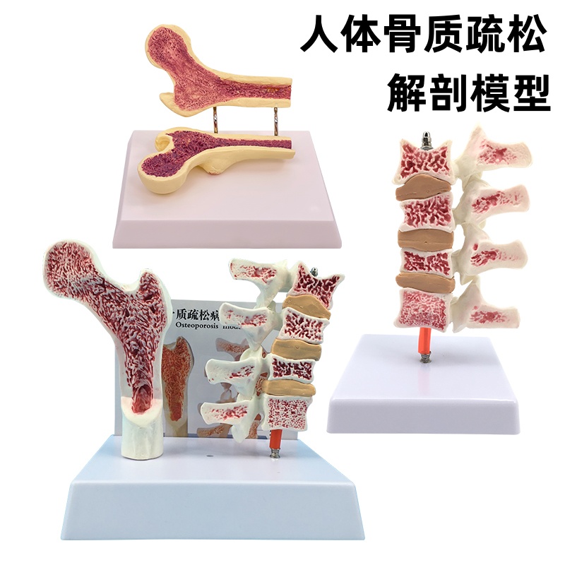 解剖模型人体股骨骨质疏黄和教学