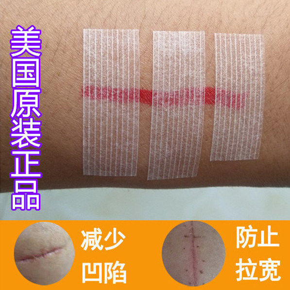 5包美国3M免缝胶布术后减张贴拉合胶带儿童脸部防宽【1.2×10cm】