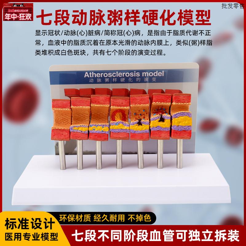 人体心脑血管动脉粥样硬化堵塞模型血栓血液脂肪v病理解剖医学教