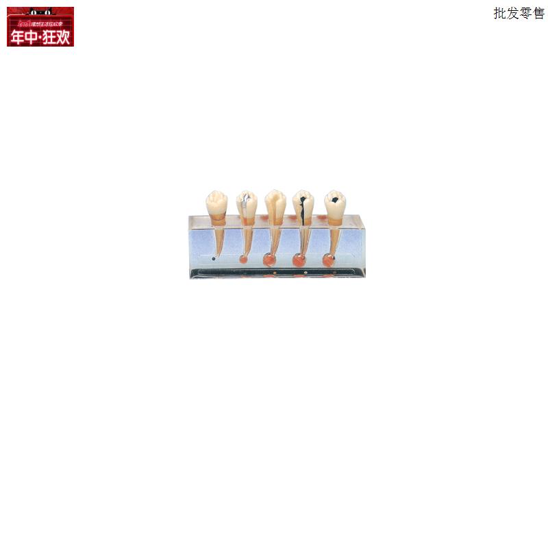 牙齿病变系F列模型B10015/2