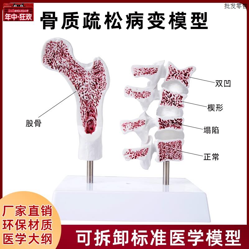 仿真人体骨质疏松骨骼股骨头脊椎双凹塌陷楔形病理变正z常教学模