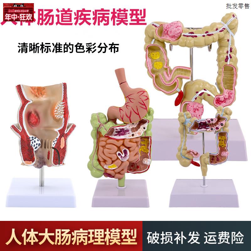 教学仿真人体大肠病理模型结f肠直肠肠胃病变解剖肠道疾病结肠病