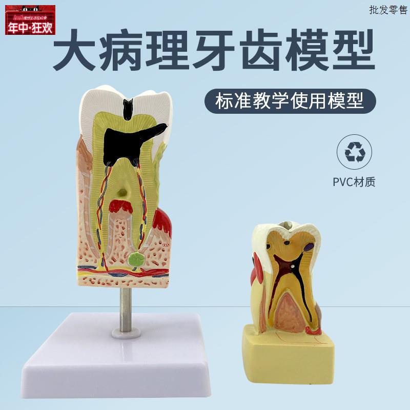 蛀牙模型牙齿病变四倍牙体综b合病理模型牙齿解剖齿科医患沟通