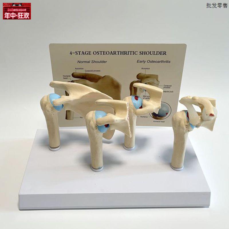 肱骨头旋转肩关节病理模型四阶段损M伤医用展示医患教育用模型