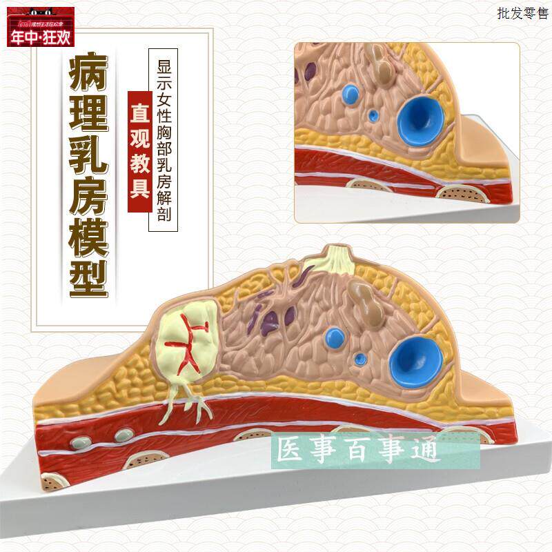 正品乳房常见疾病乳房病理解剖结构模L型乳房模具妇科模型包邮