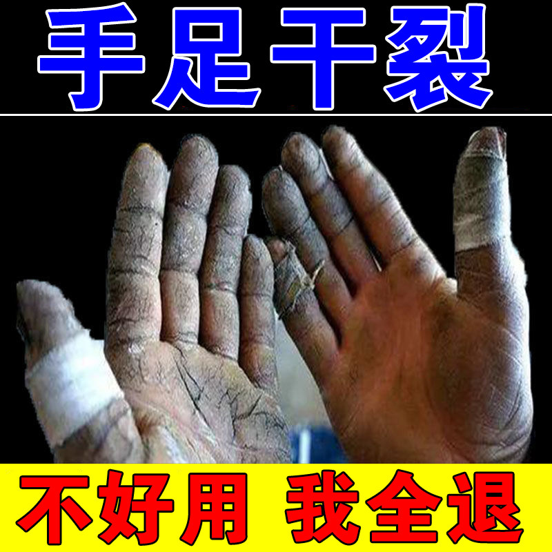 儿童手背皴裂图片,儿童手背发红皲裂_大山谷图库