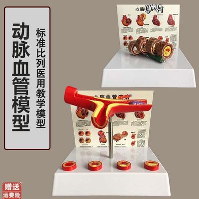 人体支脉粥样形k成模型血管模型血液科动脉模型教学血管模型