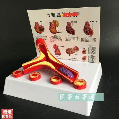 动脉模型硬化带血栓模型动脉血管粥样硬J化带血栓病变器官内脏模
