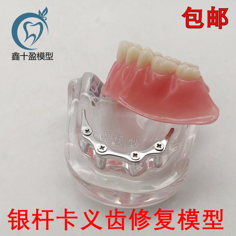 牙科口腔模型 齿科修复模型t 银杆卡 医患沟通 种植修复 6008包邮
