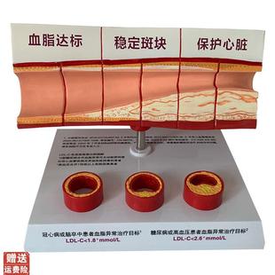 血管活动堵塞动支脉粥样硬化心血管动脉硬化N模型血管病理模型血