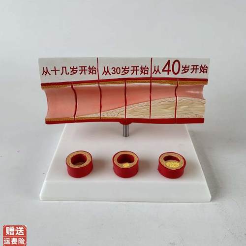 心脑血管堵塞模型关节血栓血液y浓度脂肪病理粥样硬化人体解剖教