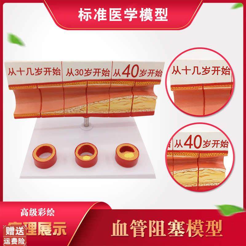 人体血管模型动脉血管阻塞变w化演示教学模型器官解剖结构层次模
