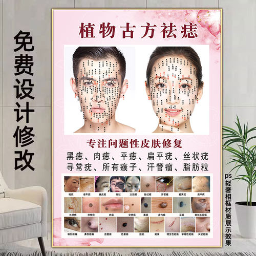 男女面痣图点痣挂画祛斑祛疣广告