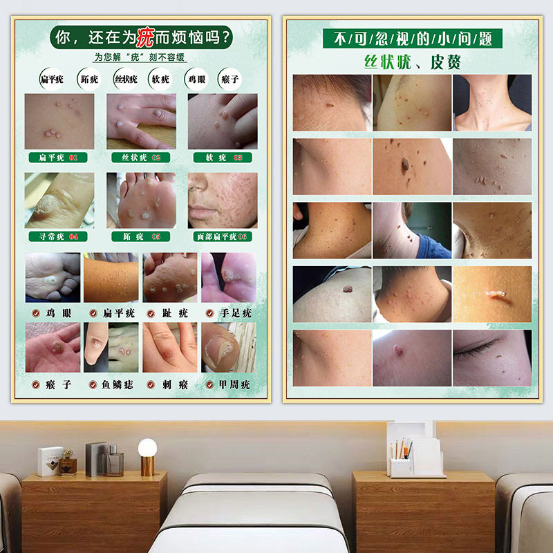 男女面痣图片美容院面部美容祛痣祛疣斑痘敏广告汗管瘤扁平疣挂画