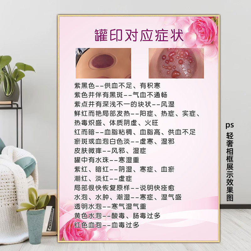拔罐海报罐印对应症状挂图中医养生刮痧图片广告宣传画经络装饰画