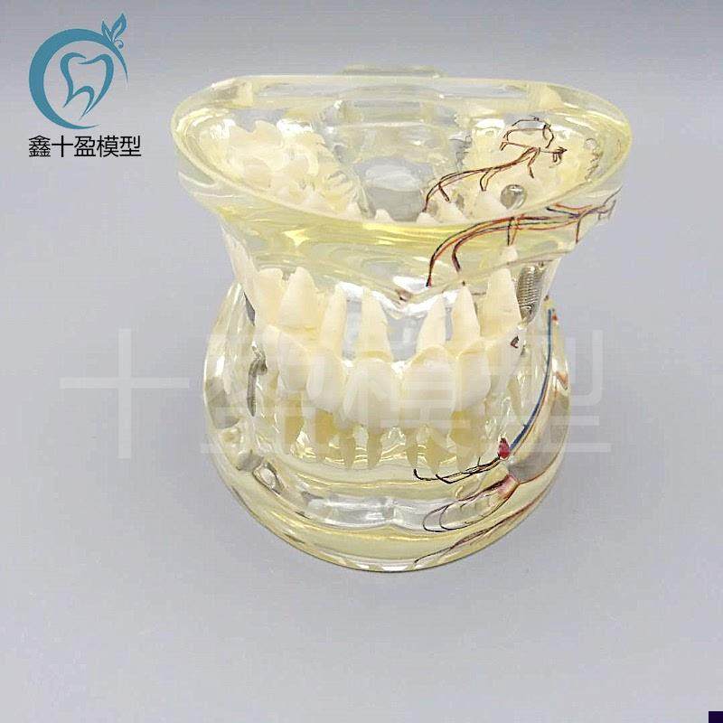 牙科水晶牙齿病g理模型M4019-2成人透明病理牙模型带牙神经和嵌体
