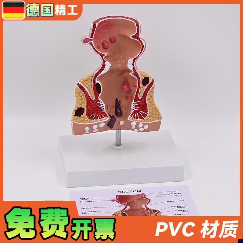 德国】新款大促爆l款人体模型肠直肠解剖病理模型病态疾病教具模