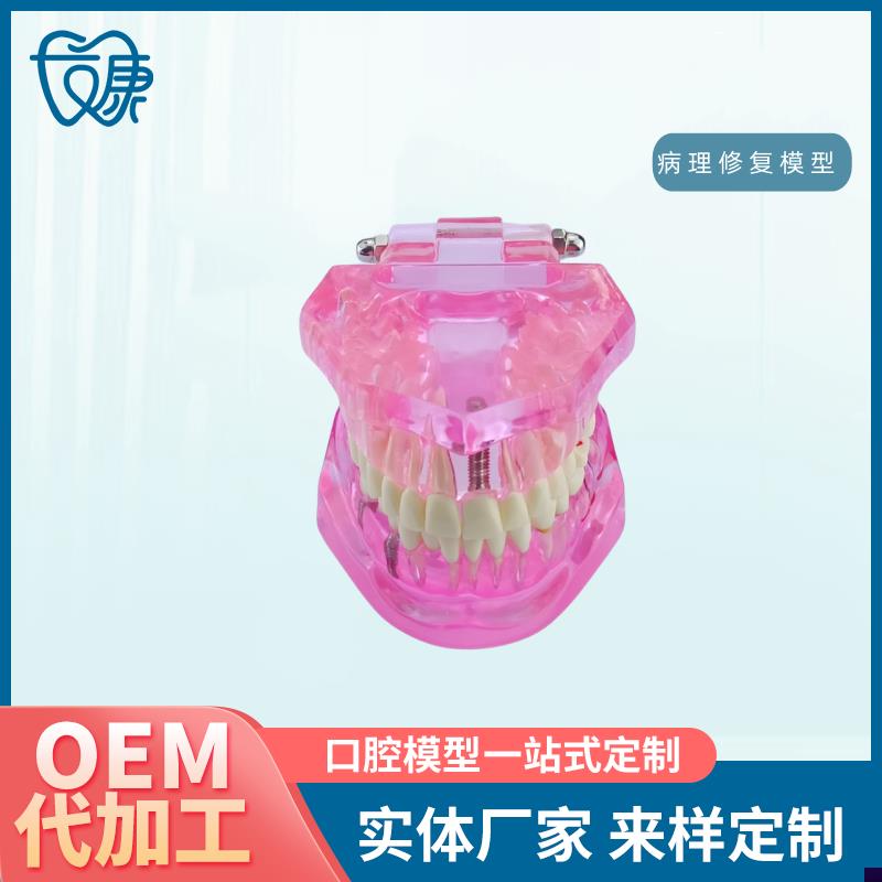 牙齿模型病理修i复可拆卸正畸口腔病理牙模型牙科医患活动沟通